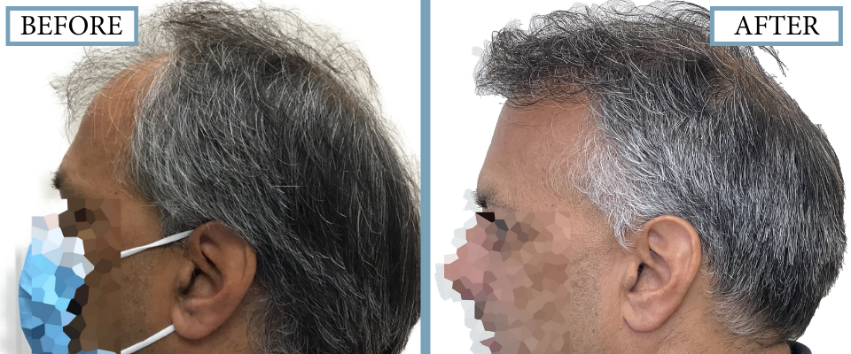 THTS Before and After FUT/Strip
