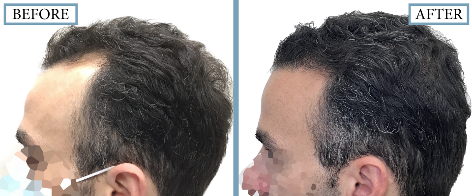 THTS Before and After FUE