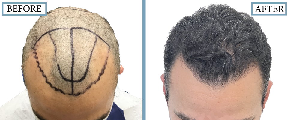 THTS Before and After FUE