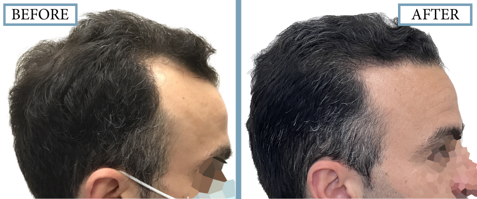 THTS Before and After FUE