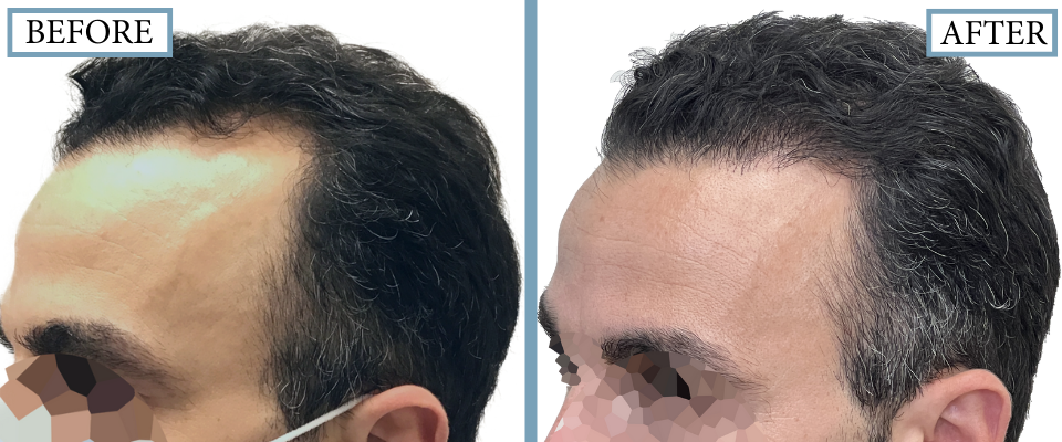 THTS Before and After FUE