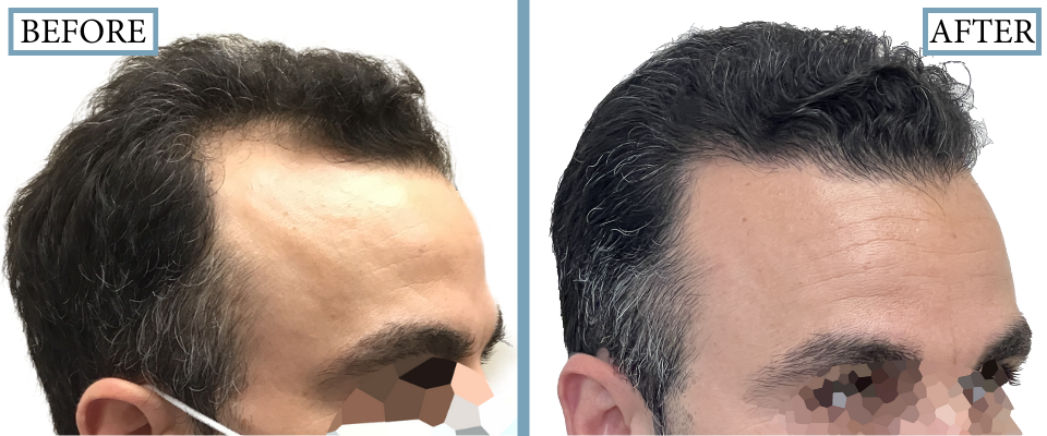 THTS Before and After FUE