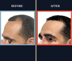 3000 G FUE Hair Transplant Results