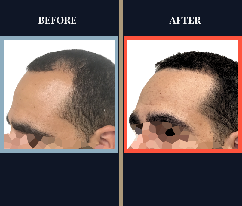 3000 G FUE Hair Transplant Results