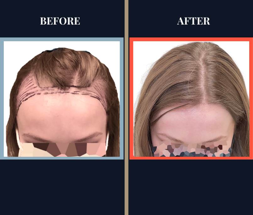 1675 G FUT Hair Transplant Results