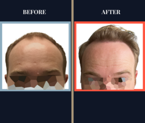 2939 G FUT Hair Transplant Results