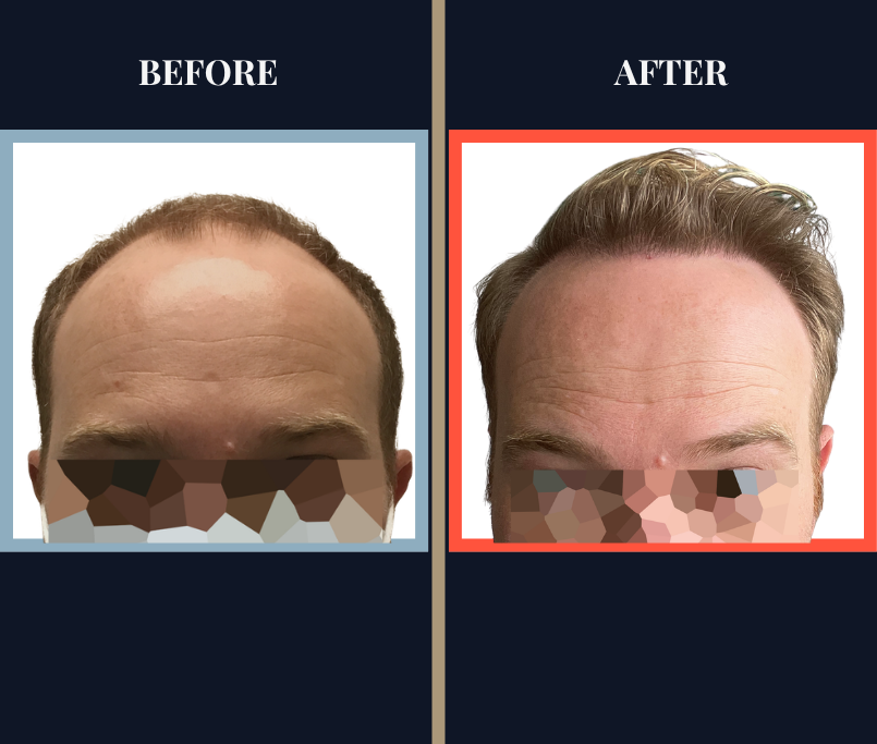 2939 G FUT Hair Transplant Results