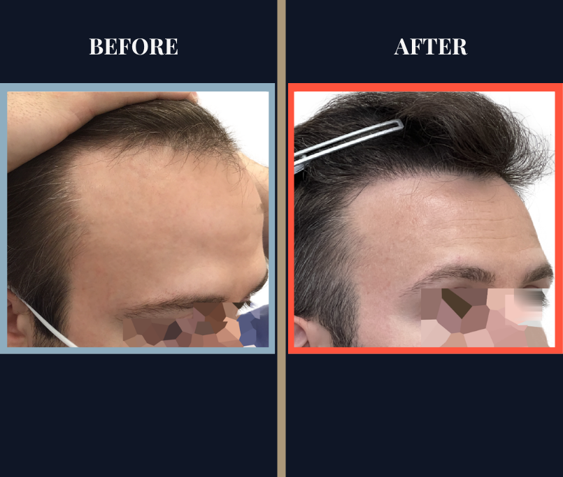 1316 G FUE Hair Transplant Results