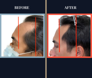 1800 G FUE Hair Transplant Results