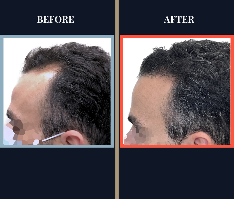 2461 G FUE Hair Transplant Results