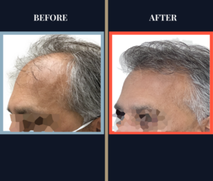 2950 G FUE Hair Transplant Results