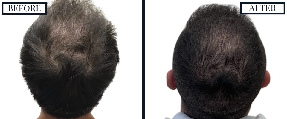 THTS 2409 Graft FUE Before and After