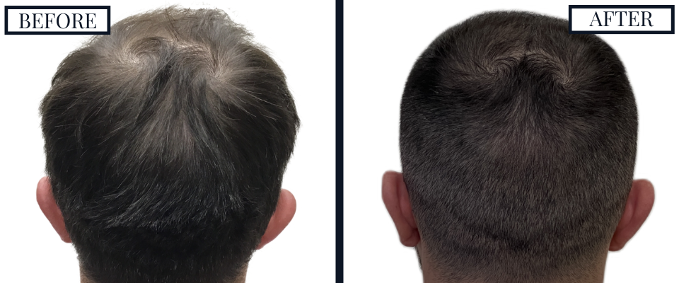 THTS 2409 Graft FUE Before and After