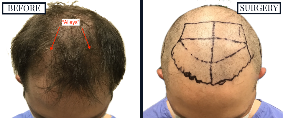 THTS 2409 Graft FUE Before and After