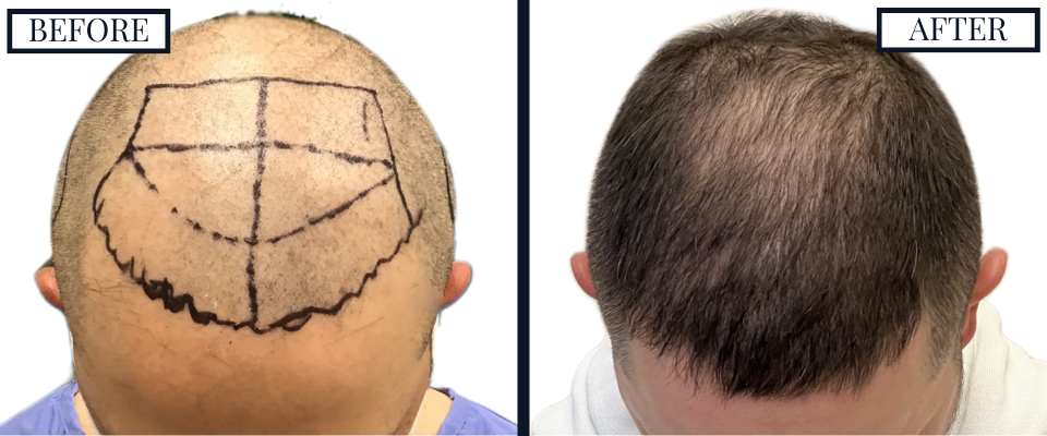 THTS 2409 Graft FUE Before and After