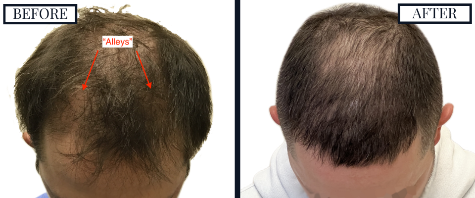 THTS 2409 Graft FUE Before and After