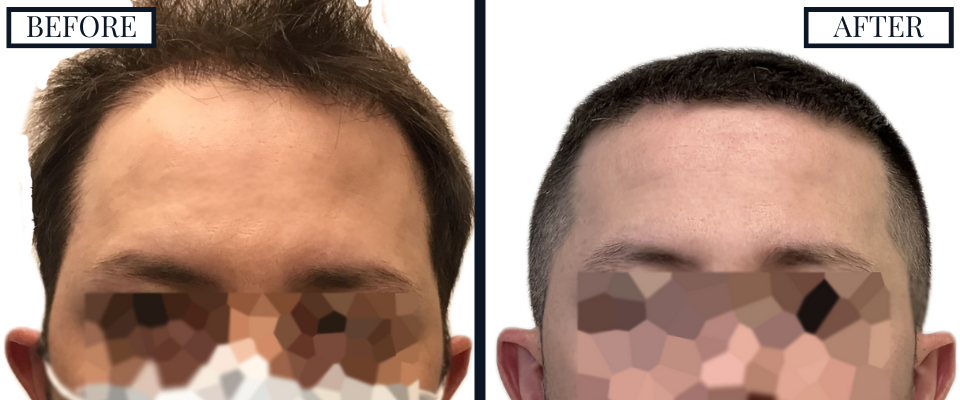 THTS 2409 Graft FUE Before and After