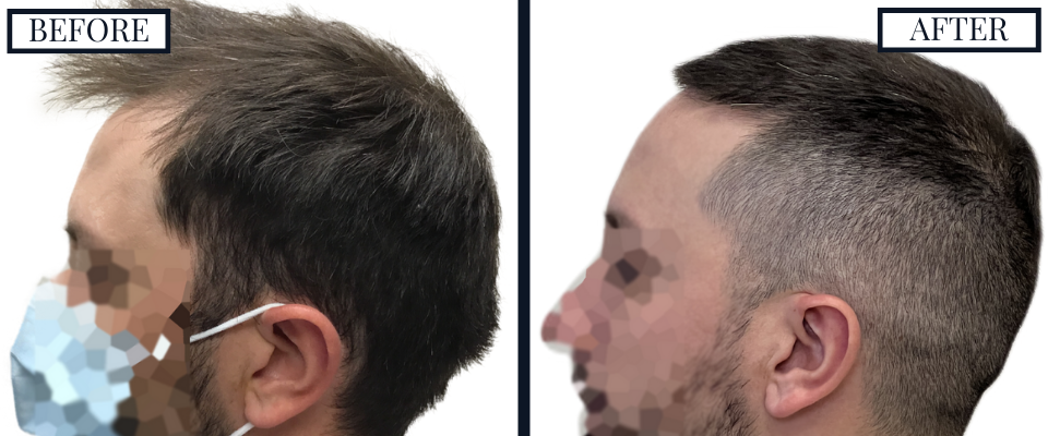 THTS 2409 Graft FUE Before and After