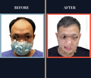 3146 G FUE Hair Transplant Results