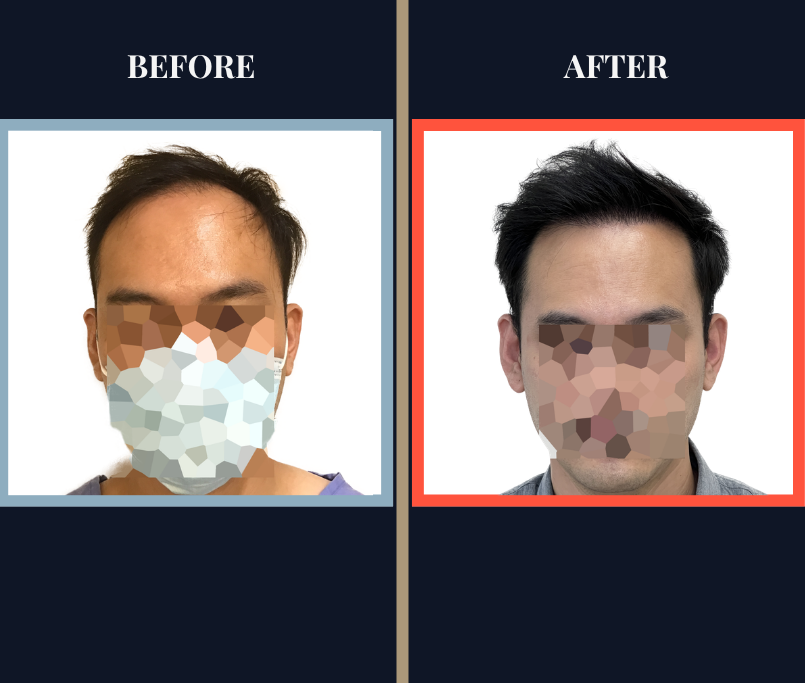 1500 G FUE Hair Transplant Results