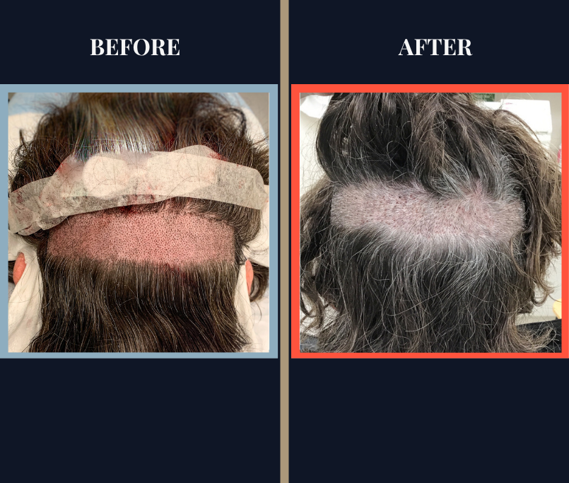 Partial No Shave FUE Hair Transplant Results
