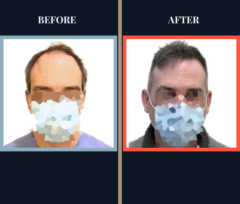 2500 G FUE Hair Transplant Results