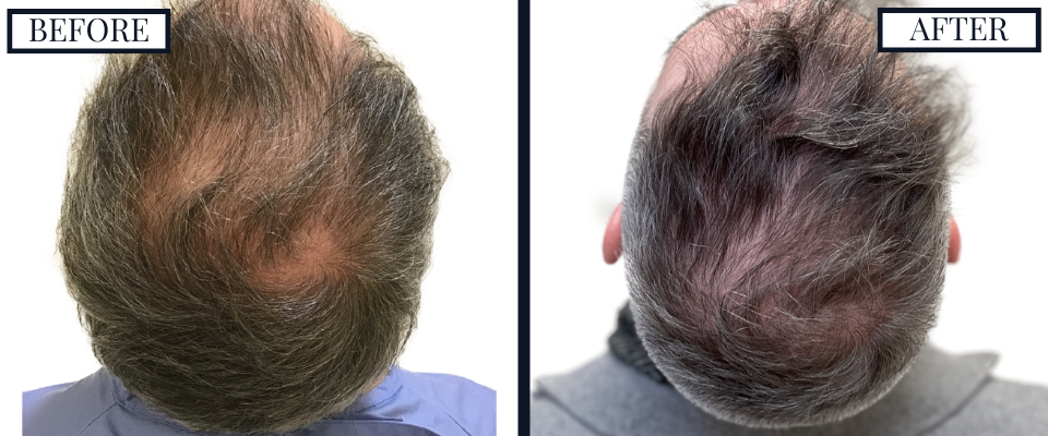 THTS 2500 Graft FUE Before and After