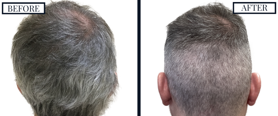 THTS 2500 Graft FUE Before and After