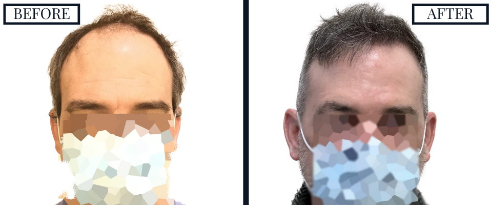 THTS 2500 Graft FUE Before and After