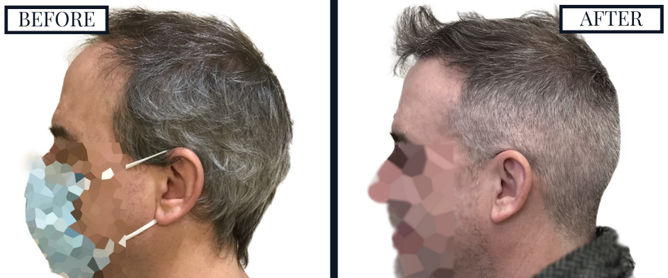 THTS 2500 Graft FUE Before and After
