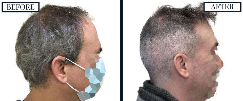 THTS 2500 Graft FUE Before and After