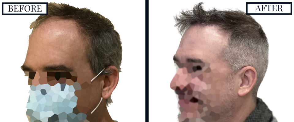 THTS 2500 Graft FUE Before and After