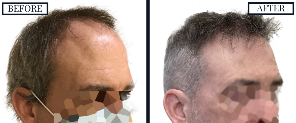 THTS 2500 Graft FUE Before and After