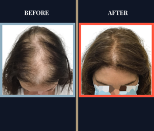 Non-Surgial Results FI