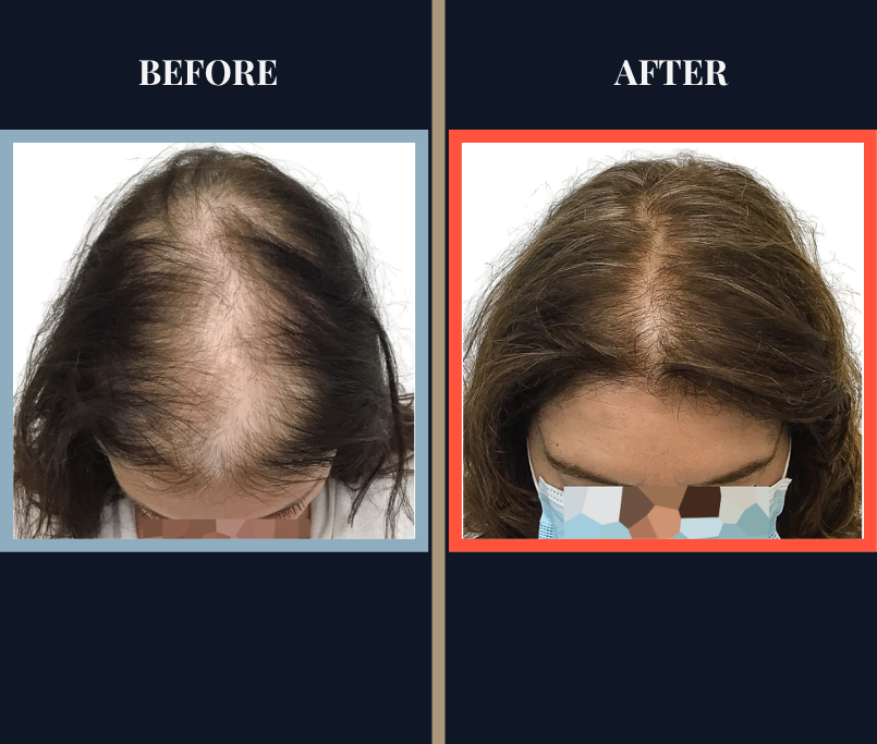 Non-Surgial Results FI