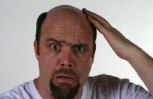 Male Pattern Baldness 300x199 Image Male Pattern Baldness 300x199 Image