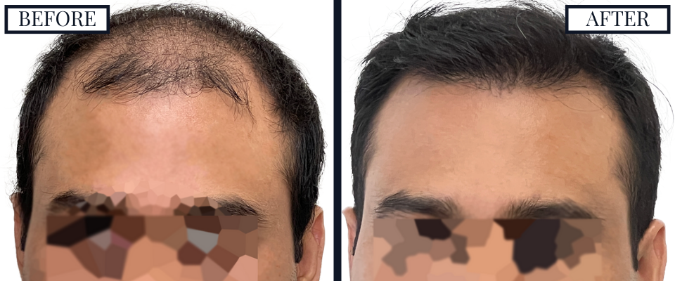 Before and After - Front