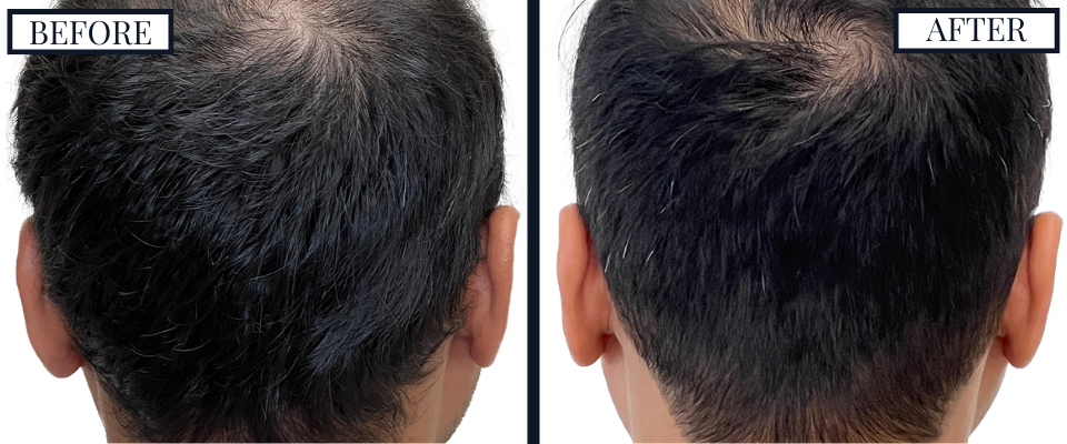 Before and After - Back