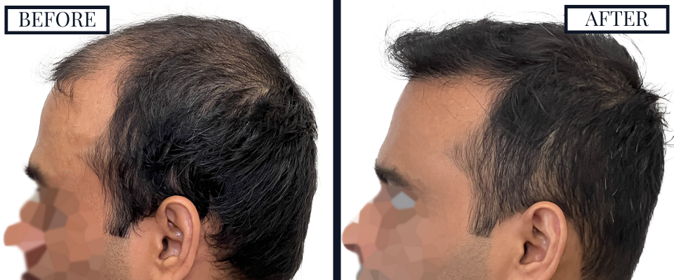 Before and After - Left