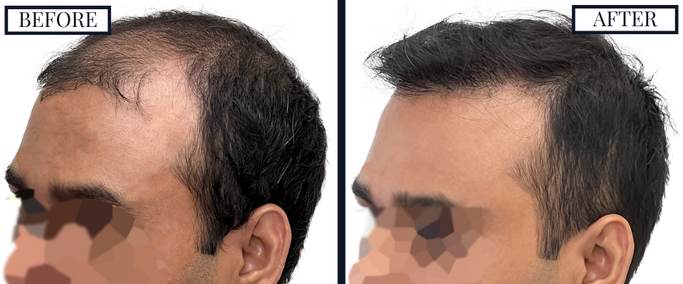 Before and fFter - Left Oblique