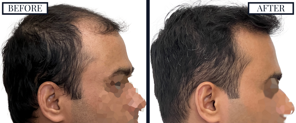 Before and After - Right