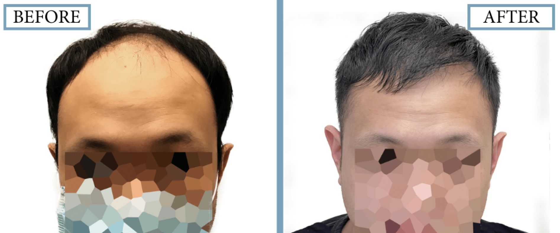 Before and After Results