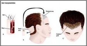 FUE for Hair Restoration FUE for Hair Restoration