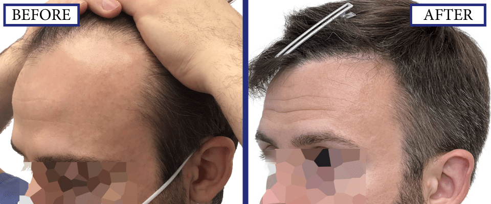 Hair Transplant Before and After Results