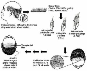 Type of Hair Transplant Type of Hair Transplant
