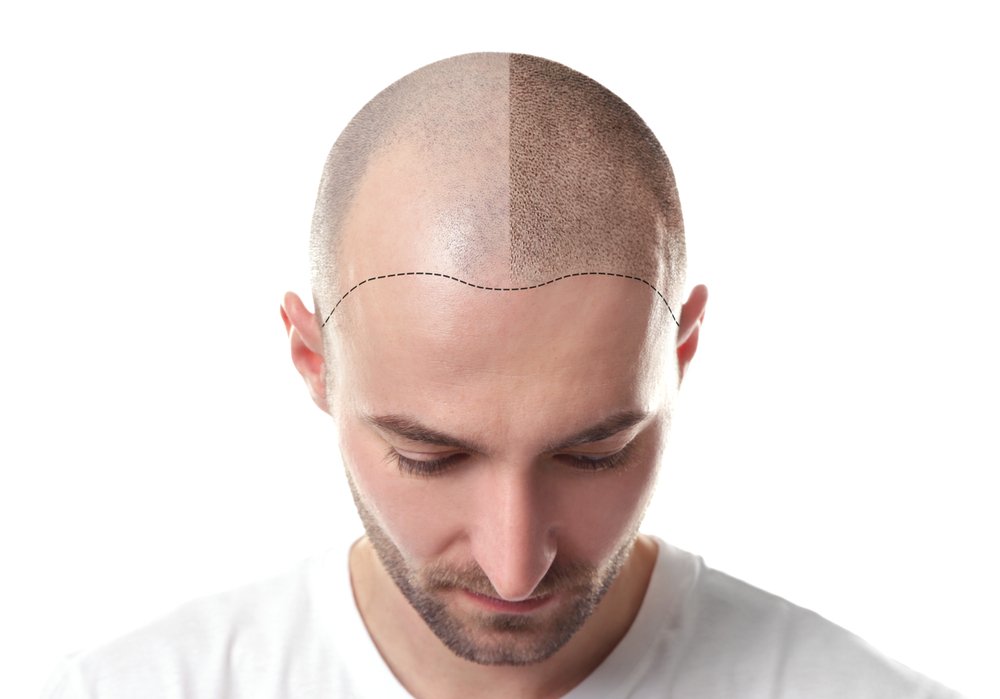 Hair Transplant- THTS