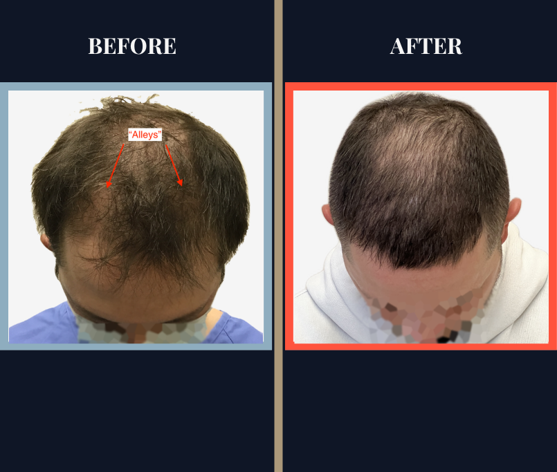 2409 HAIR TRANSPLANT RESULTS