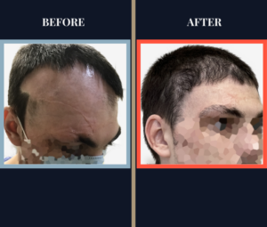 SCAR REVISION HAIR TRANSPLANT BEFORE AND AFTER RESULTS