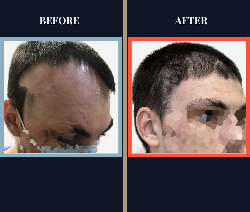 SCAR REVISION HAIR TRANSPLANT BEFORE AND AFTER RESULTS