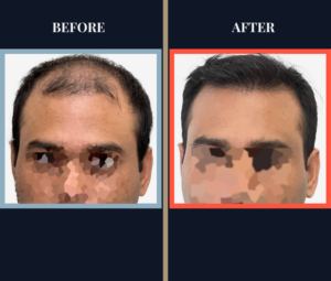 2112 GRAFT HAIR TRANSPLANT BEFORE AND AFTER RESULTS